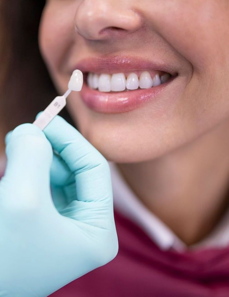 Dental Veneers