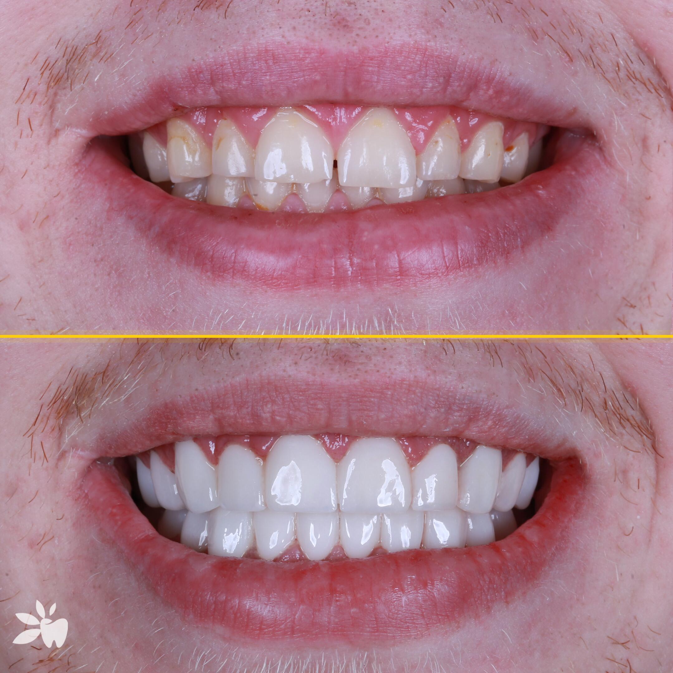 Ace-before-after-post