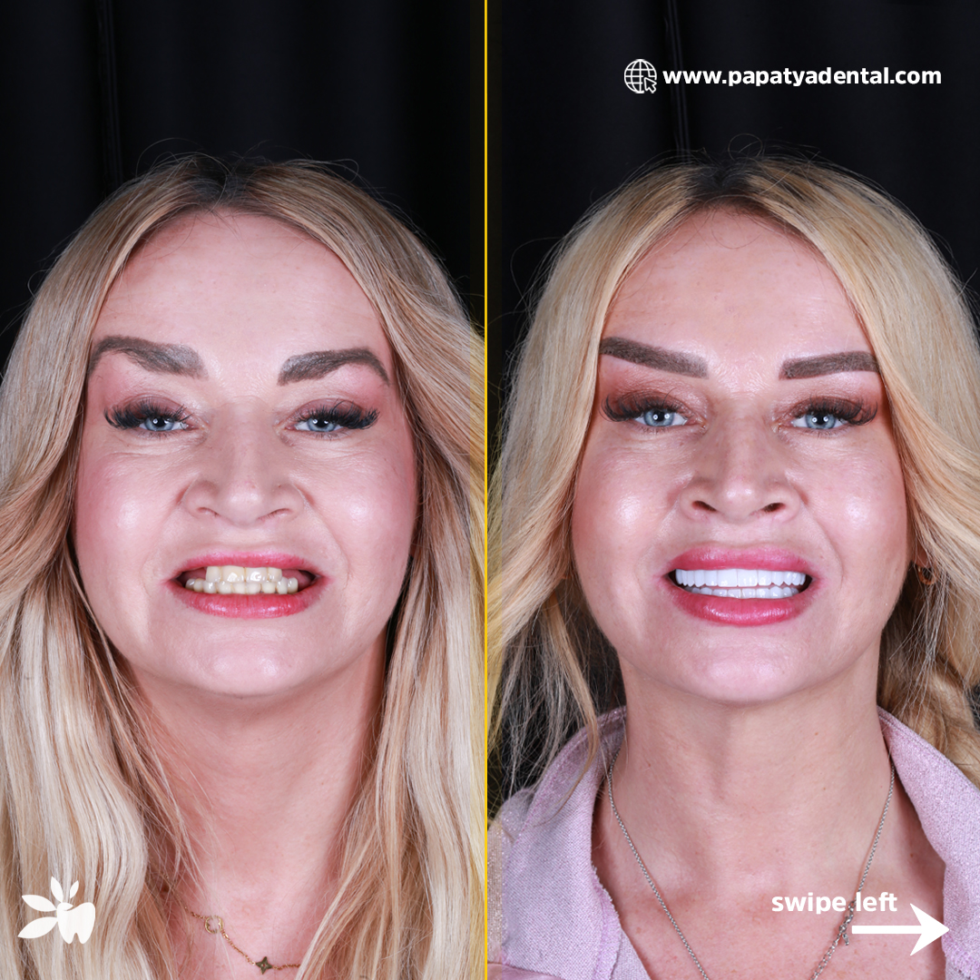 Agnieszka-Fierek-before-after-face