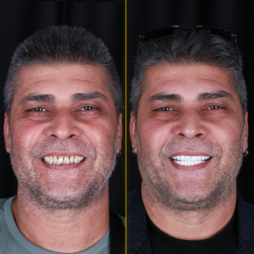 Ayhan-before-after-face