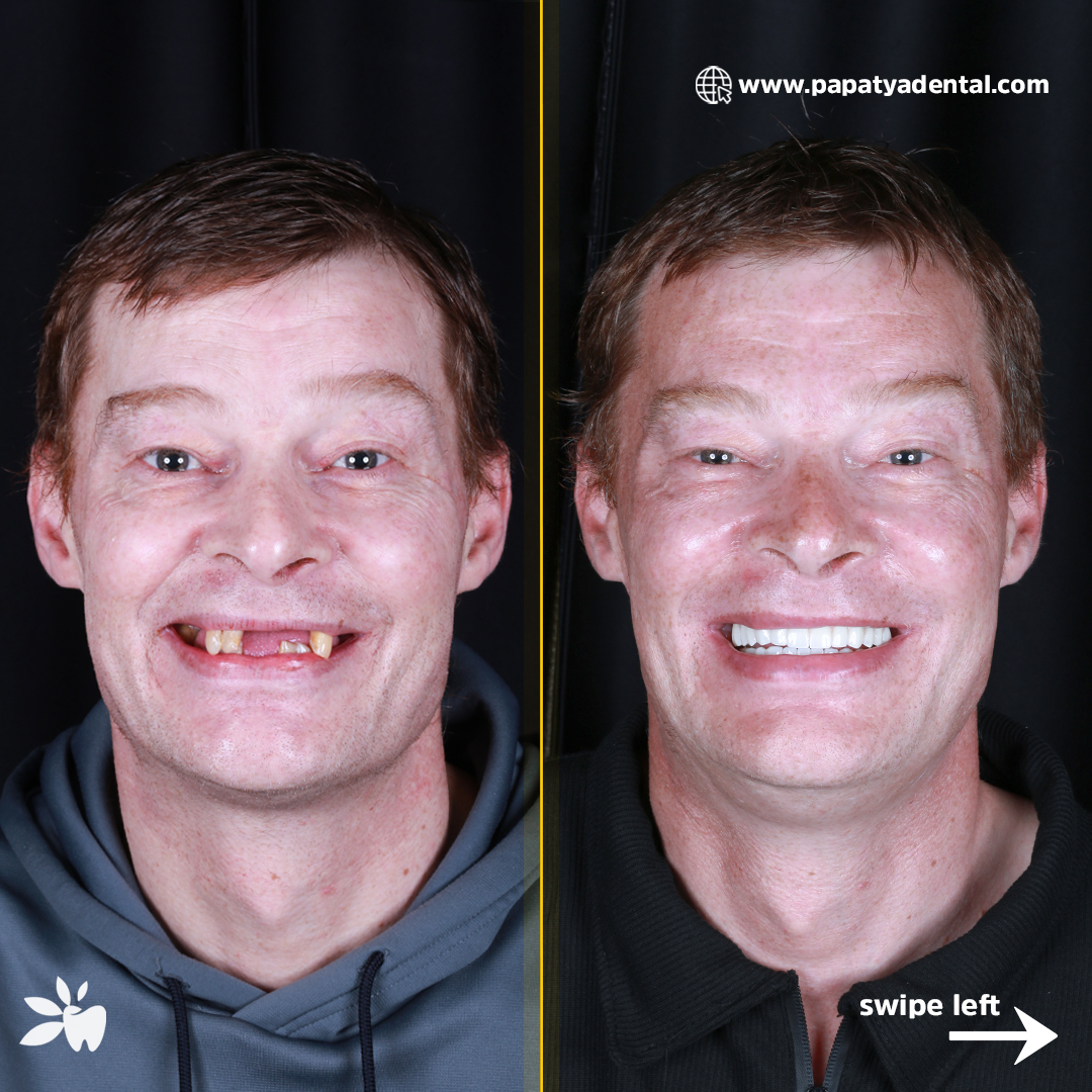 Finbarr-before-after-face