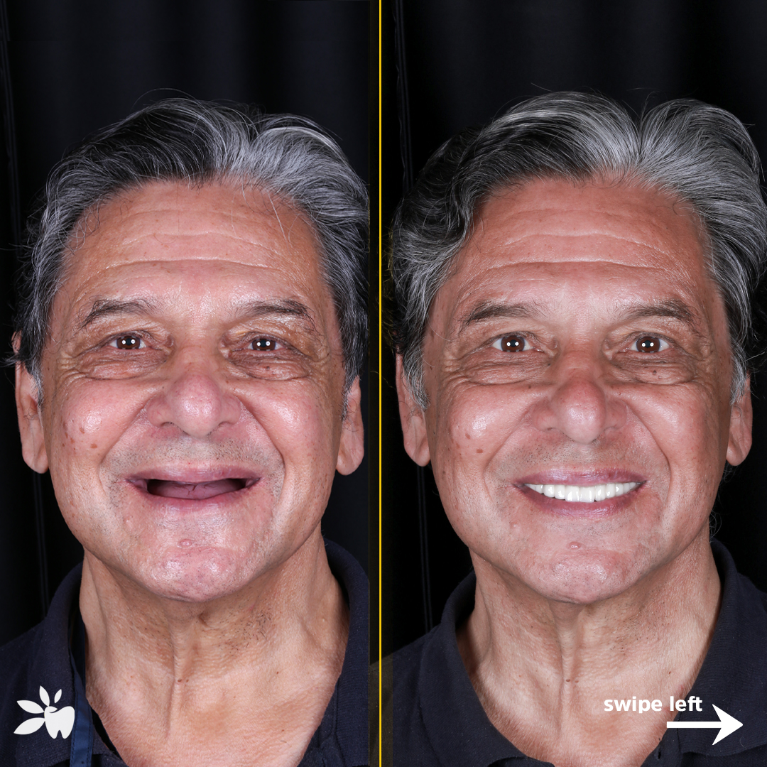 Leopold-before-after-face