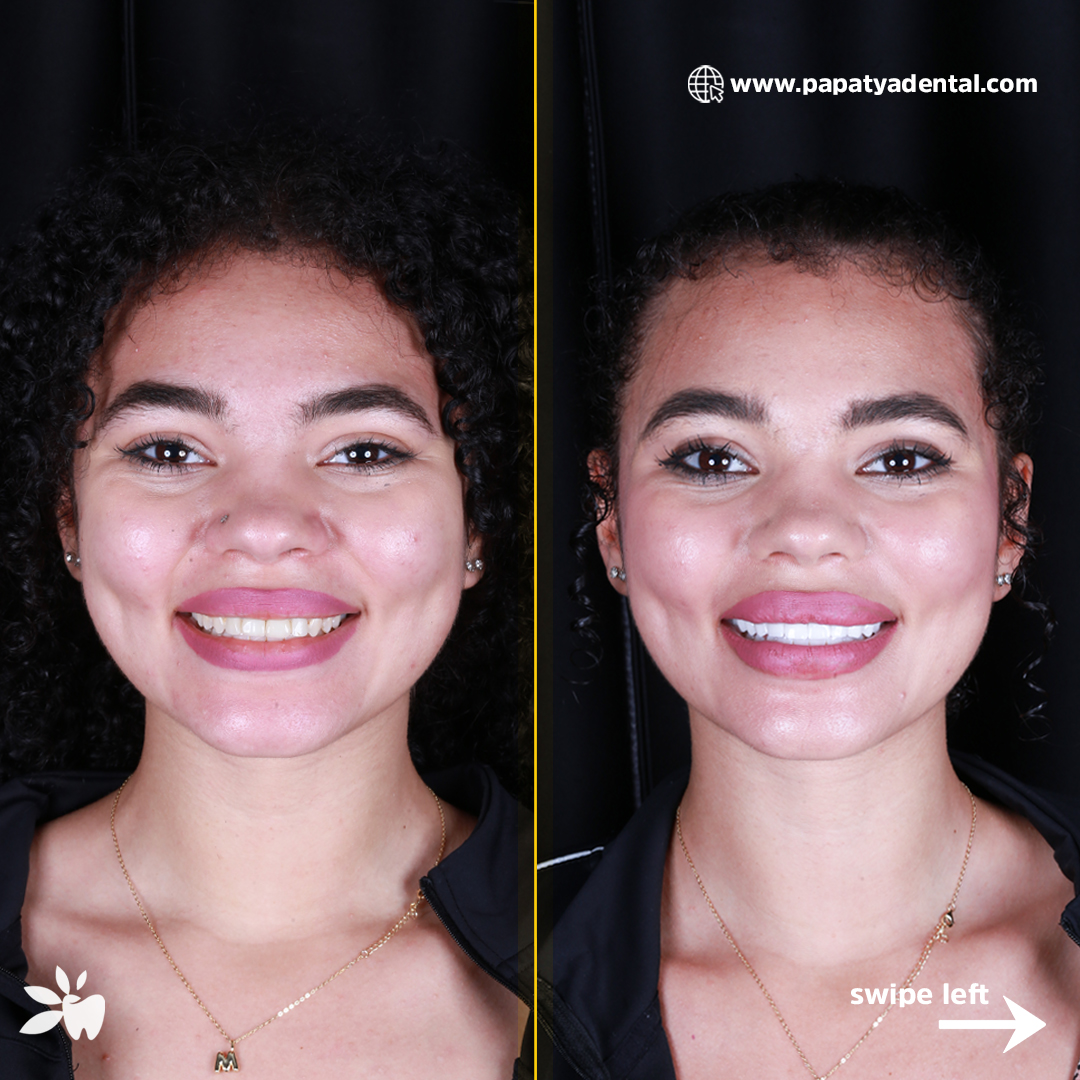 Mikayla-before-after-face