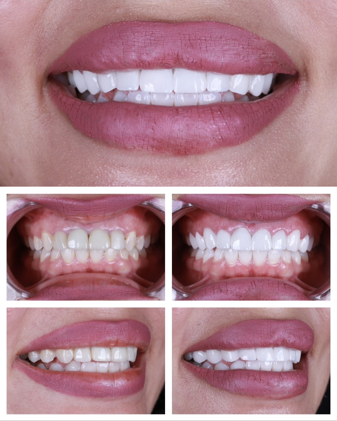 Mikayla-before-after-post-tr