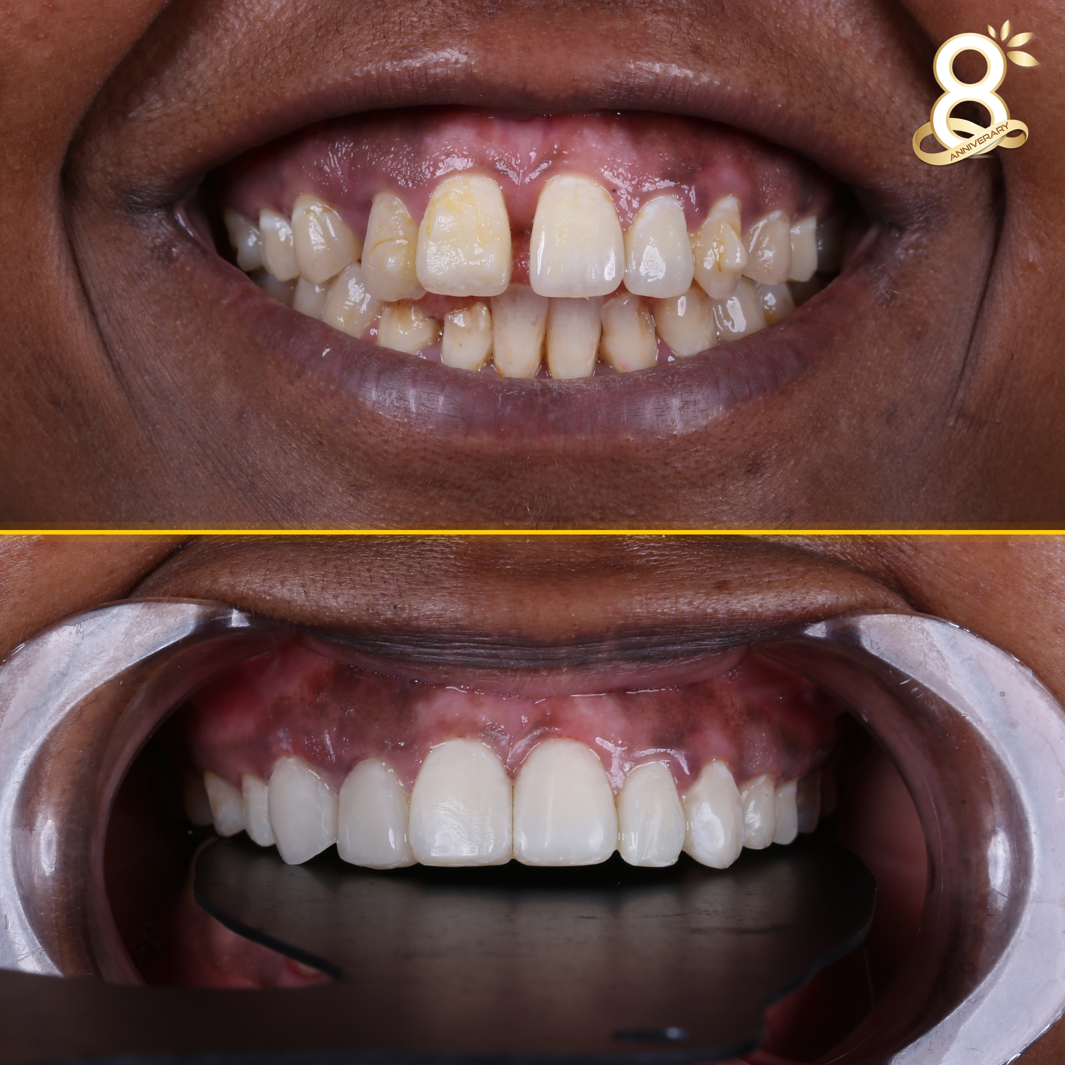 Muna-composite-bonding-before-after