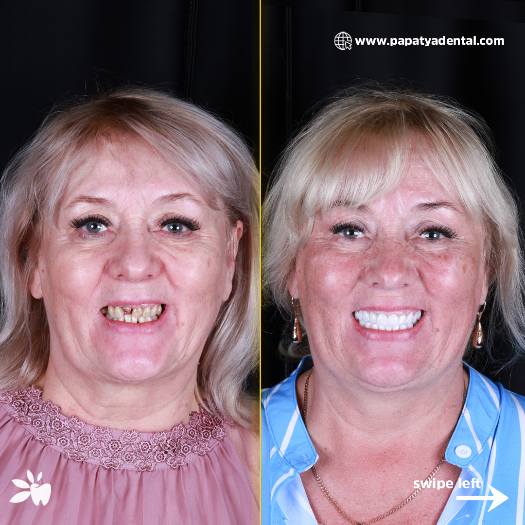 Olga-before-after-face