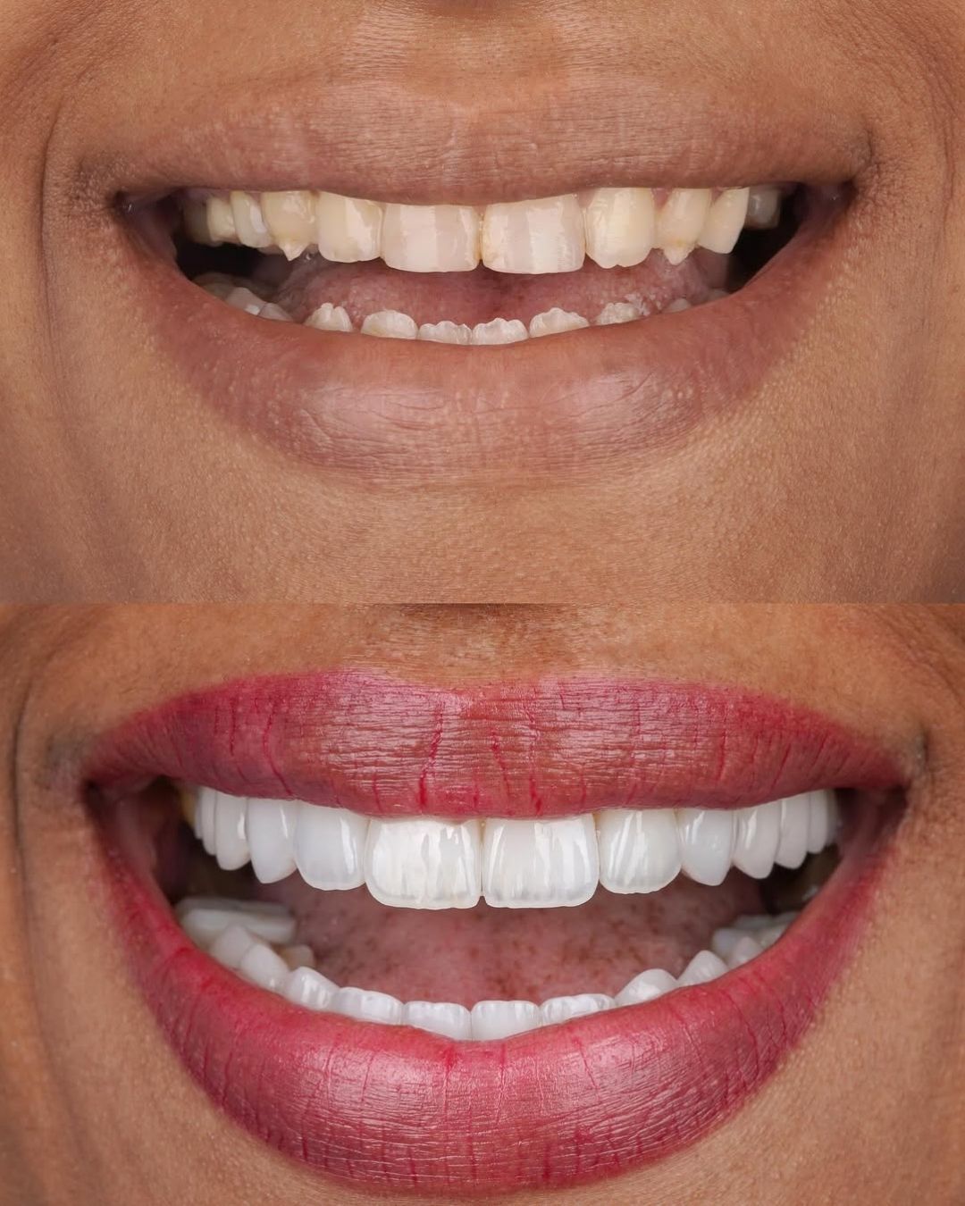 Hollywood Smile