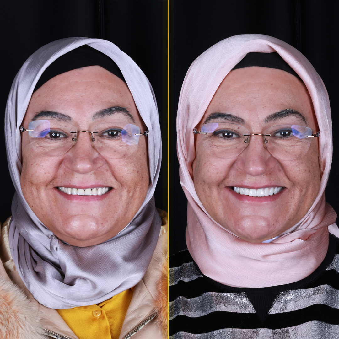 Tulay-before-after-face