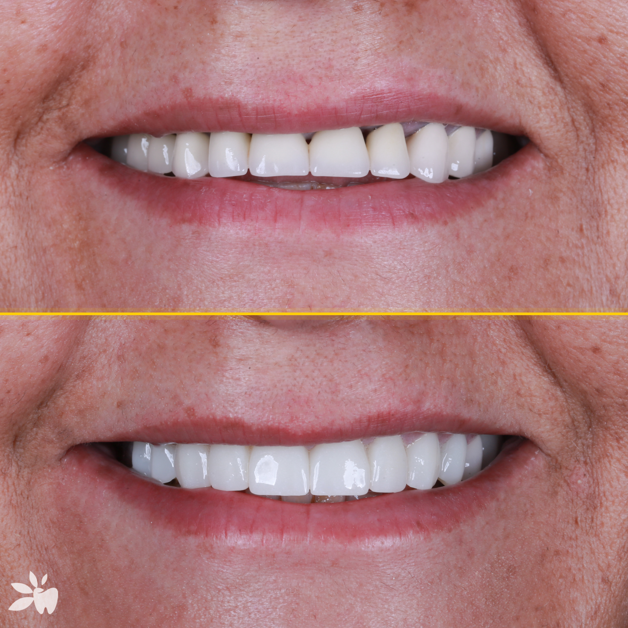Tulay-before-after-post