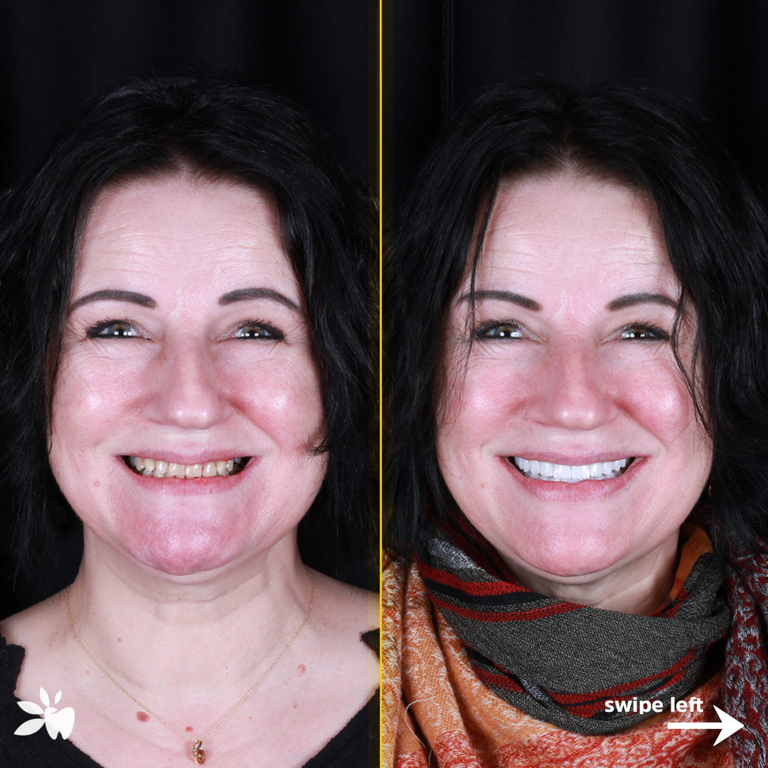 Wanja-before-after-face