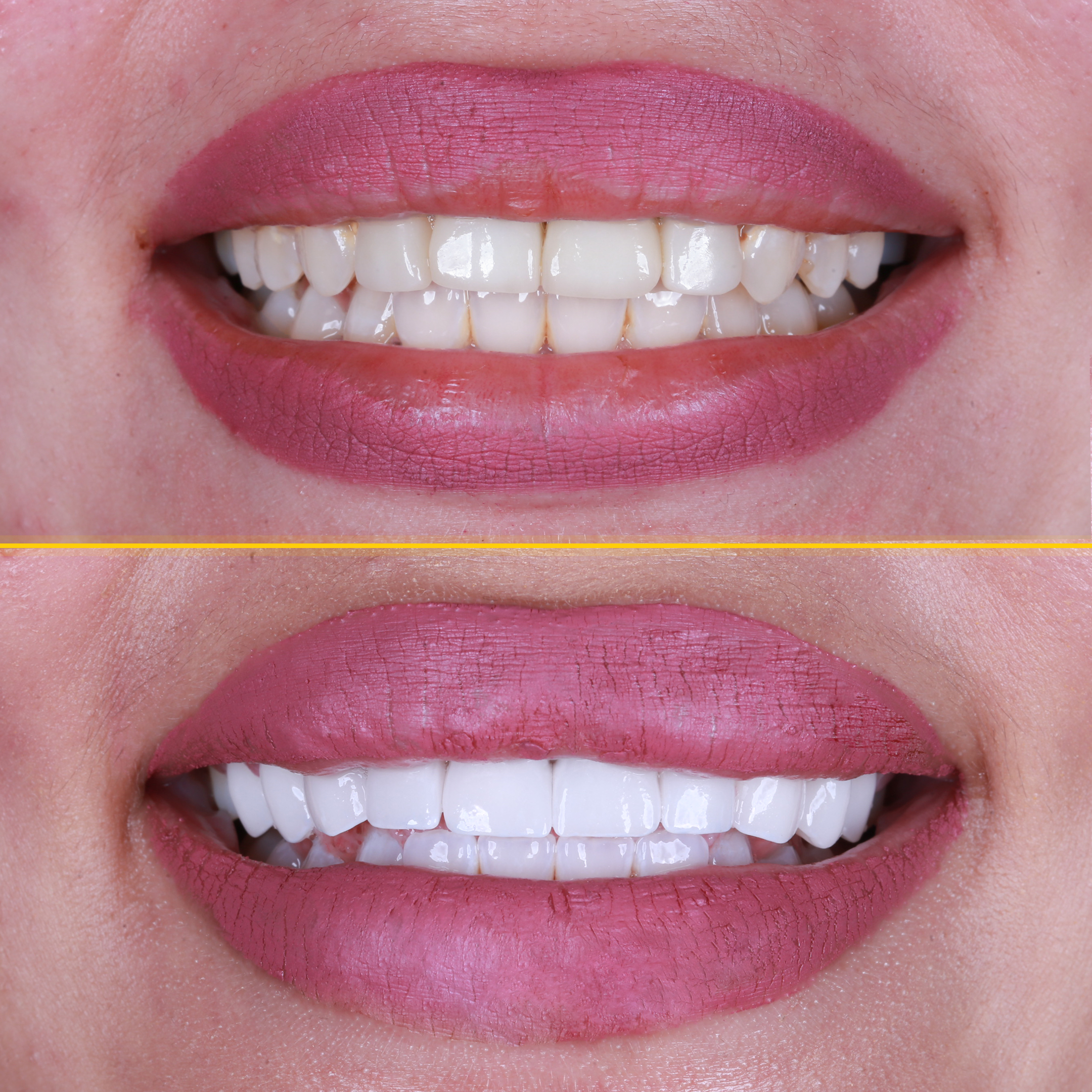 e-max-before-after